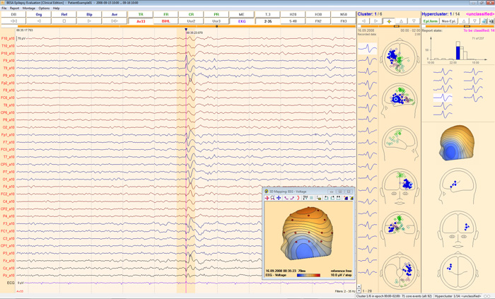 image-content-top_besa-epilepsy-overview