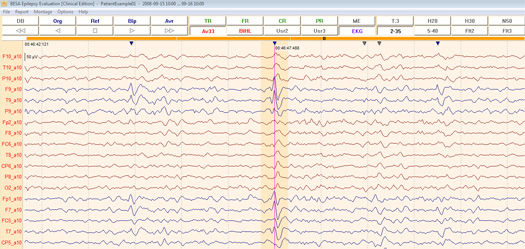 image-content-top_besa-epilepsy-features-spike-detection