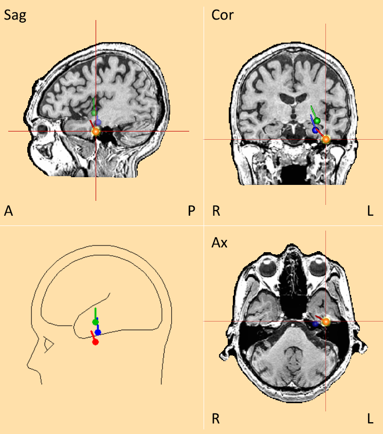 Basal temporal lobe epilepsy - dipole sources reconstructed from the interictal EEG. Green: 4-shell ellipsoidal model; blue: standard FEM model; red: individual FEM model