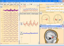 SA-Seizure-Onset