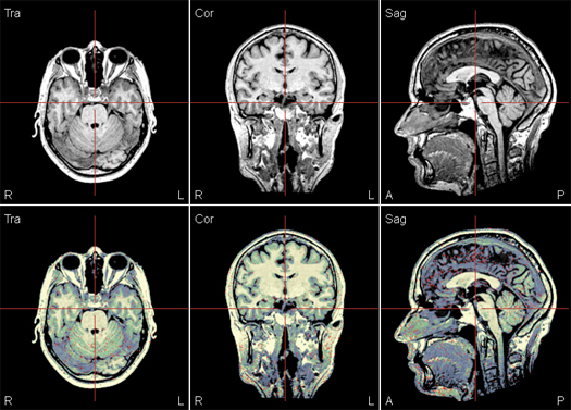 image-content-top_besa-mri-features-inhomogeneity-correction